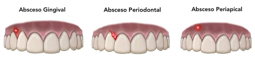Abscesos Gingivales: Diagnóstico y Tratamiento