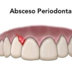 Abscesos Gingivales: Diagnóstico y Tratamiento