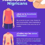 Acantosis Nigricans: Clave para Detectar Enfermedades