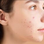 Ácido succínico: El secreto para una piel radiante