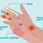 Artritis en las manos: Diagnóstico y alivio