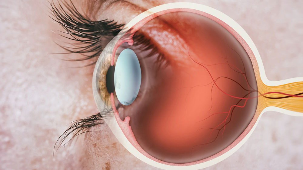 Artritis Psoriásica: Riesgo Ocular Grave