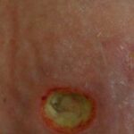 Artritis Reumatoide: Erupciones Cutáneas y Tratamiento