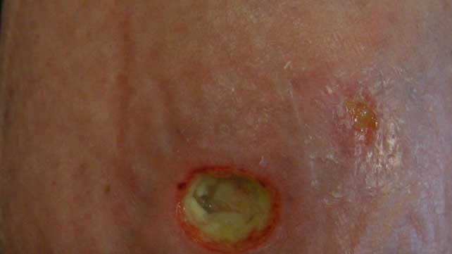 Artritis Reumatoide: Erupciones Cutáneas y Tratamiento