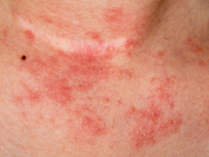 Azufre contra el eczema: ¿mito o realidad?