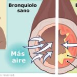Broncoespasmos: Síntomas, causas y tratamiento