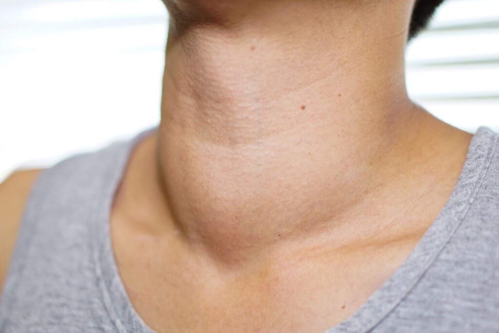 Bulto en el cuello: ¿infección, tumor o qué?
