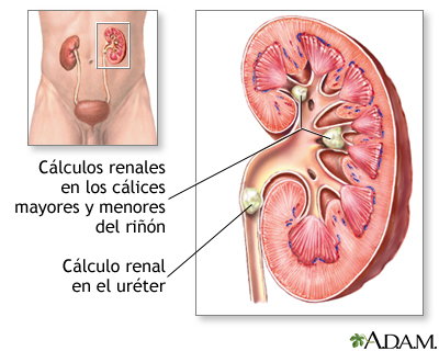 Cálculos Renales: Dolor, Diagnóstico y Tratamiento