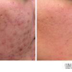 Cicatrices de acné: Guía de tratamientos efectivos