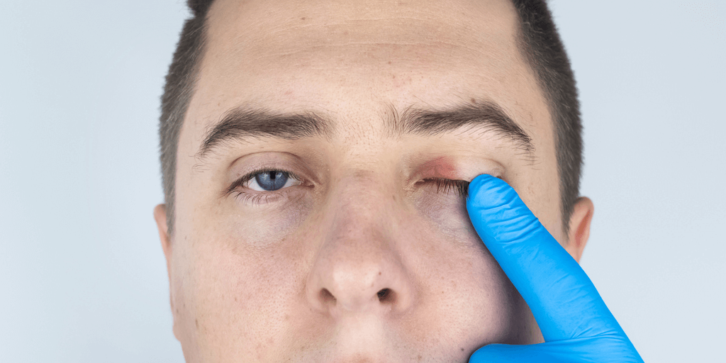 Crohn: Impacto Ocular y Manifestaciones