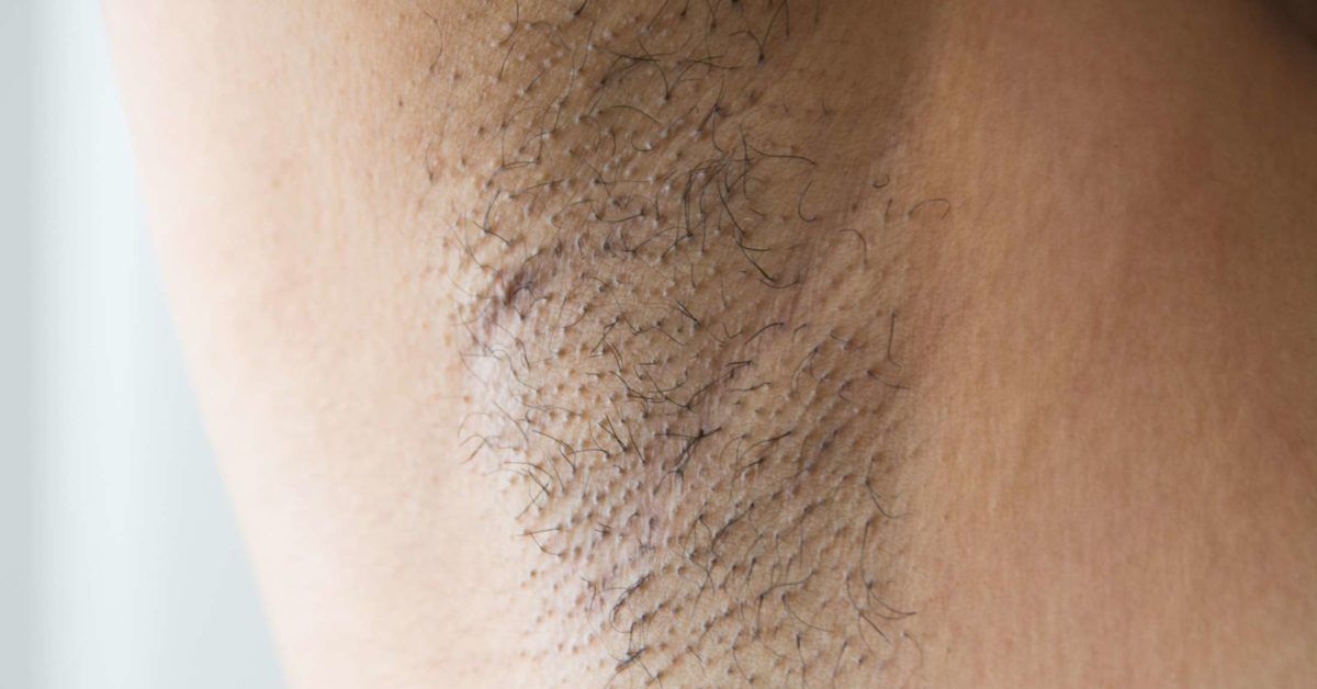 Dolor Axilar: Causas y Posibles Enfermedades