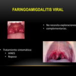 Dolor de garganta unilateral: ¿Qué puede ser?
