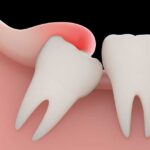 Dolor de muelas del juicio: Remedios y cuándo acudir al dentista