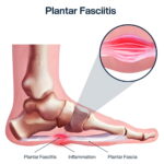 Dolor de Talón: Causas y Tipos de Lesiones