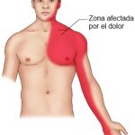 Dolor en el brazo izquierdo: ¿ataque al corazón u otra causa?