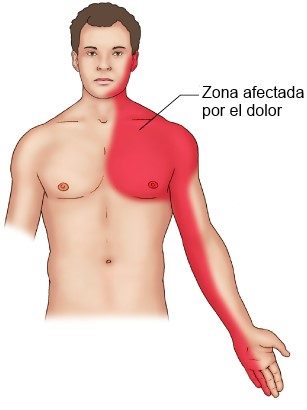 Dolor en el brazo izquierdo: ¿ataque al corazón u otra causa?