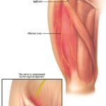 Dolor en el Muslo Superior: Causas y Síntomas