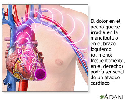Dolor en el pecho izquierdo: ¿ataque al corazón?