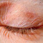 Eczema de Párpados: Causas, Tipos y Tratamiento