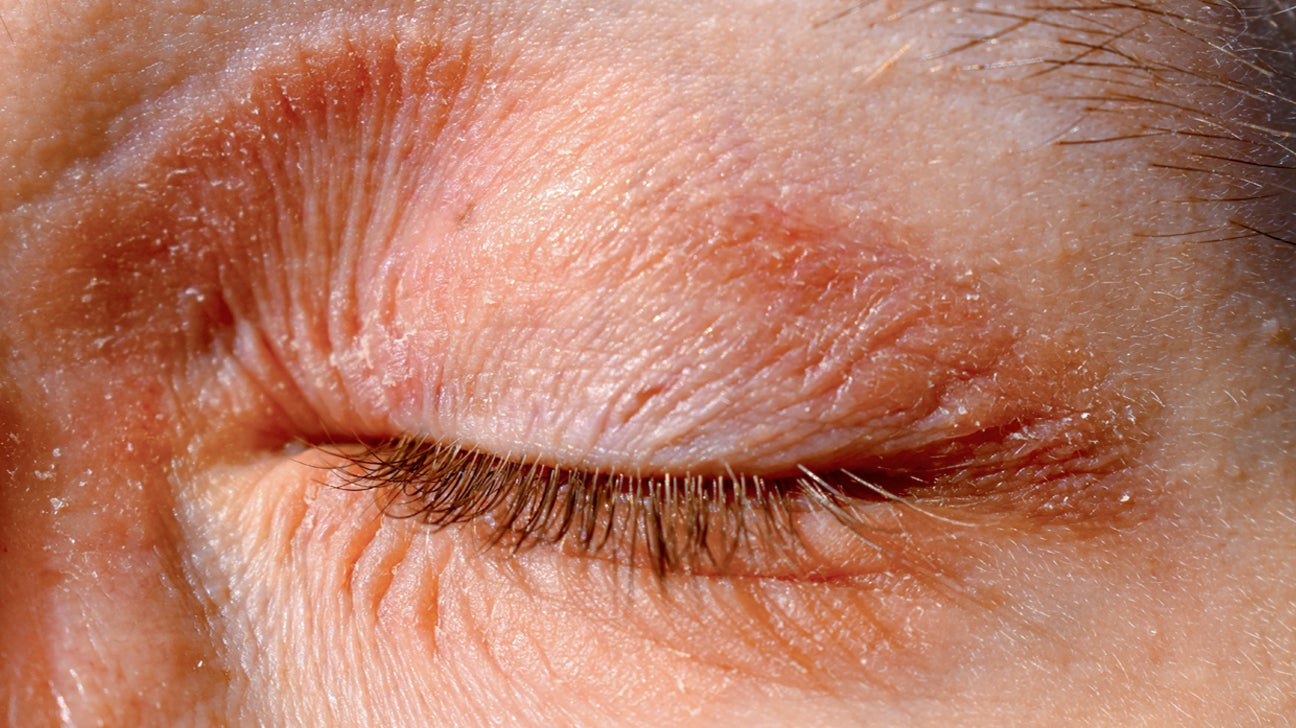 Eczema de Párpados: Causas, Tipos y Tratamiento