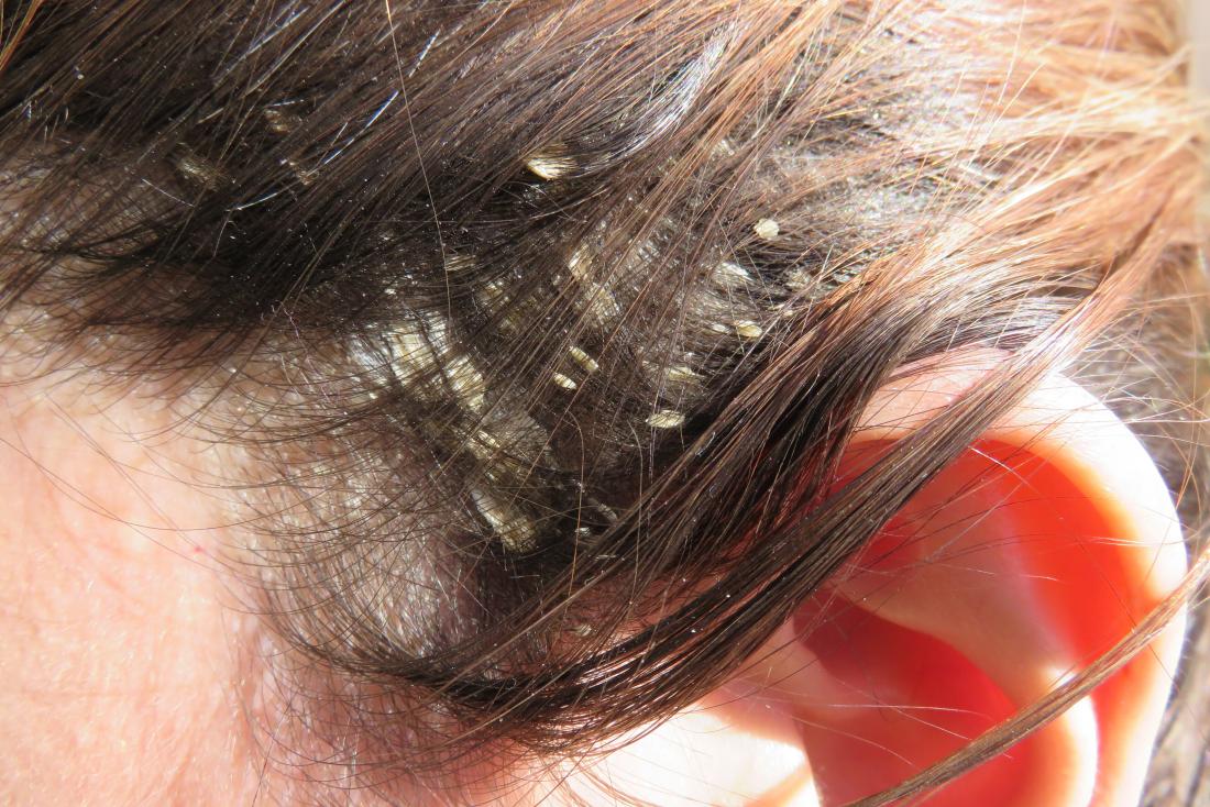 Eczema del cuero cabelludo: síntomas, causas y tratamientos