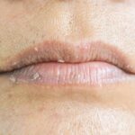 Eczema labial: Diagnóstico, tratamiento y prevención