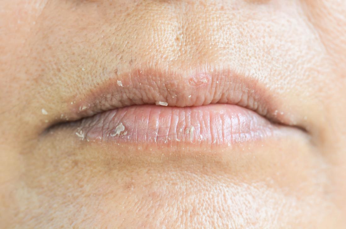 Eczema labial: Diagnóstico, tratamiento y prevención