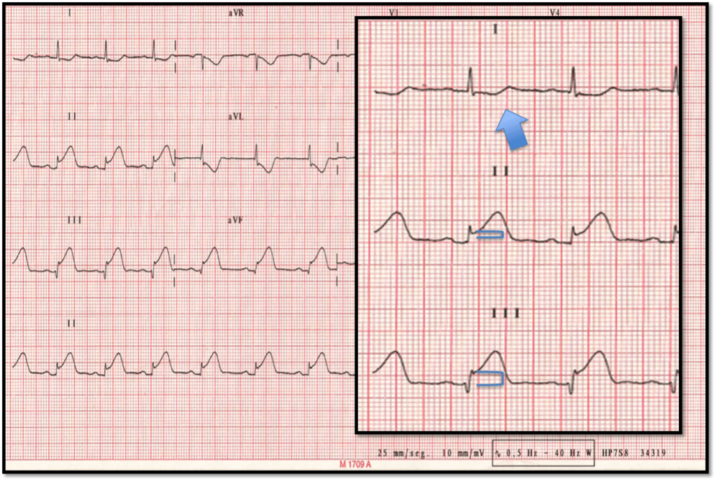 Electrocardiograma: ¿Útil pero insuficiente para diagnosticar infartos?