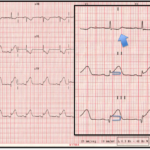 Electrocardiograma: ¿Útil pero insuficiente para diagnosticar infartos?