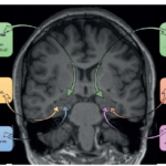 Epilepsia del lóbulo temporal: daño cerebral y envejecimiento