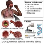 EPOC: Síntomas, Causas y Tratamiento Efectivo