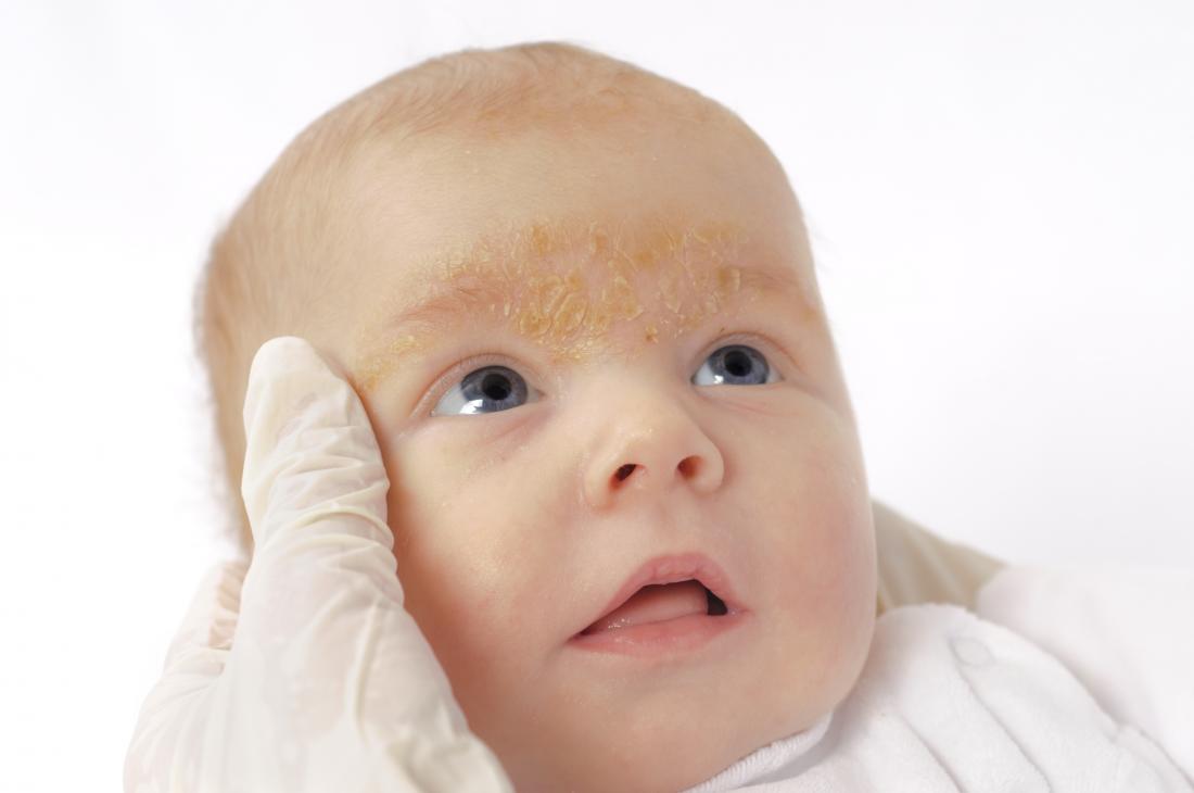 Erupciones faciales en bebés: causas y tratamiento