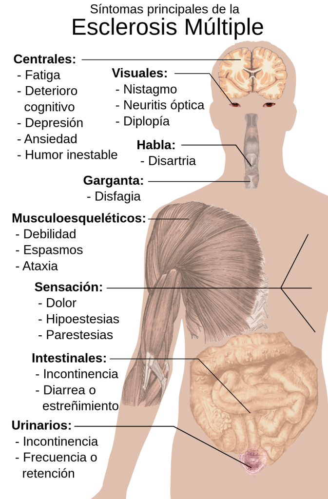 Esclerosis Múltiple: Síntomas, Tipos y Diagnóstico