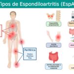 Espondiloartritis: Dolor, inflamación e impacto sistémico