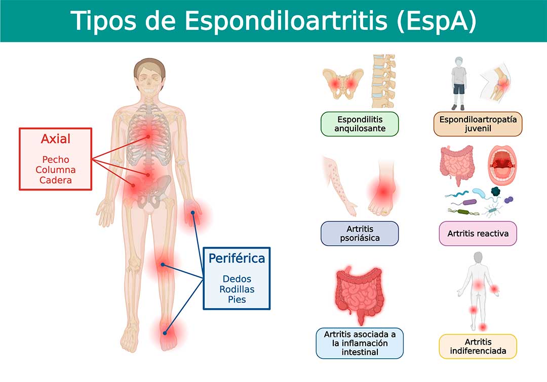 Espondiloartritis: Dolor, inflamación e impacto sistémico