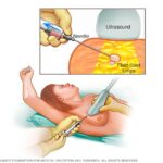 Fibrosis quística mamaria: Diagnóstico y alivio