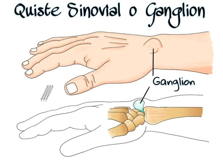 Ganglión en mano o muñeca: causas, síntomas y tratamiento - Blog ...