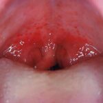 Garganta Irritada: Causas y Tratamientos
