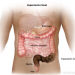 Heces atascadas: Causas y factores de riesgo