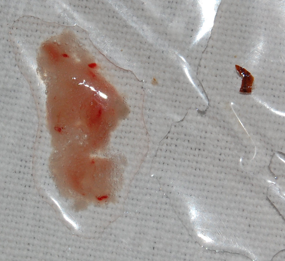 Hemoptisis: Detectando la causa de la sangre en la tos