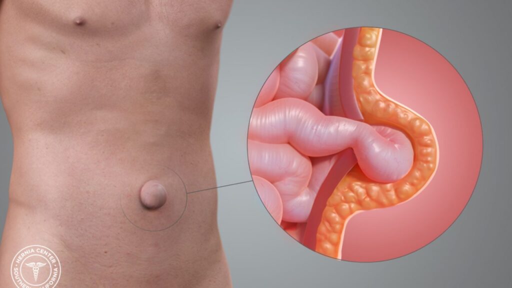 Hernias Umbilicales: Causas, Tratamiento y Riesgos