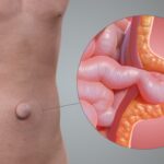 Hernias Umbilicales: Causas, Tratamiento y Riesgos