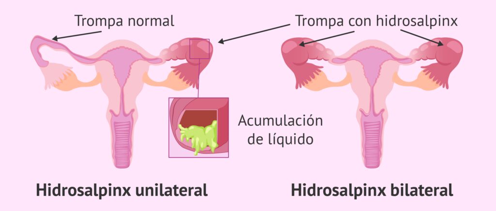 Hidrosálpinx: Salpingectomía, tratamiento y alternativas para trompas obstruidas.