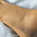 Hinchazón en Pies y Tobillos: Causas y Tratamientos