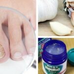 Hongos en las uñas: Remedios caseros y tratamientos