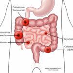 Ileostomía: Cirugía, recuperación y tipos de estoma