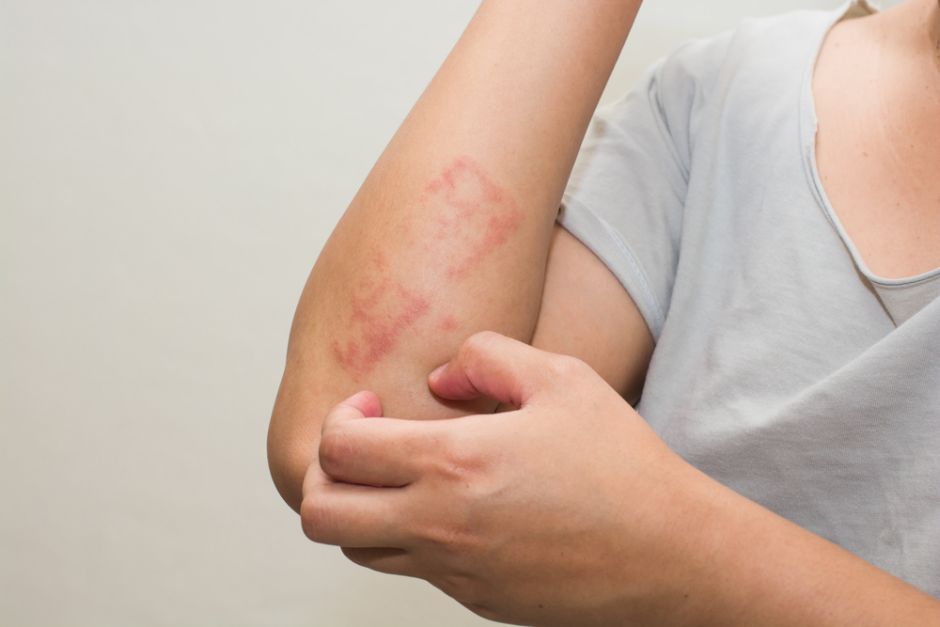 Infecciones de la Piel: Síntomas, Causas y Tratamiento