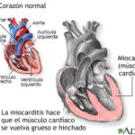 Inflamación del corazón: Síntomas, causas y tratamiento
