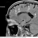 IRM: Clave para diagnosticar y monitorizar la esclerosis múltiple