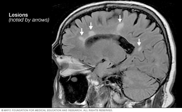 IRM: Clave para diagnosticar y monitorizar la esclerosis múltiple